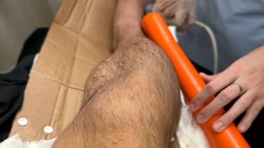 Карьера под угрозой? Исмагулов шокировал деталями травмы на турнире ACBJJ